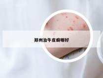 郑州治牛皮癣哪好