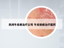 民间牛皮癣治疗公司 牛皮肤癣治疗医院