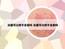 白醋可以擦牛皮癣吗 白醋可以擦牛皮癣吗