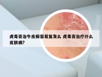 虎毒膏治牛皮癣容易复发么 虎毒膏治疗什么皮肤病?