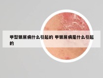 甲型银屑病什么引起的 甲银屑病是什么引起的