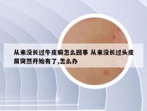 从来没长过牛皮癣怎么回事 从来没长过头皮屑突然开始有了,怎么办