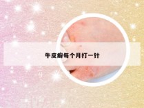 牛皮癣每个月打一针