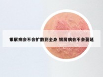 银屑病会不会扩散到全身 银屑病会不会蔓延
