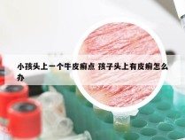 小孩头上一个牛皮癣点 孩子头上有皮癣怎么办