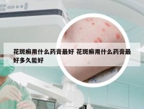 花斑癣用什么药膏最好 花斑癣用什么药膏最好多久能好