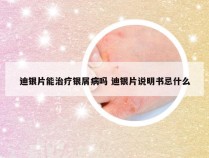 迪银片能治疗银屑病吗 迪银片说明书忌什么