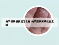 关节银屑病预后怎么样 关节型银屑病能自愈吗