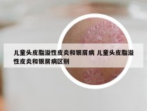 儿童头皮脂溢性皮炎和银屑病 儿童头皮脂溢性皮炎和银屑病区别