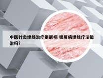 中医针灸埋线治疗银屑病 银屑病埋线疗法能治吗?