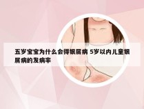 五岁宝宝为什么会得银屑病 5岁以内儿童银屑病的发病率