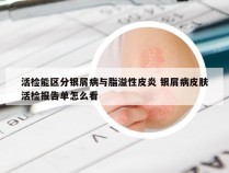 活检能区分银屑病与脂溢性皮炎 银屑病皮肤活检报告单怎么看