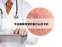 牛皮癣刚发现时是什么样子的