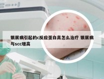 银屑病引起的c反应蛋白高怎么治疗 银屑病与scc增高