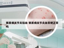 银屑病关节炎验血 银屑病关节炎血常规正常吗