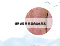 银屑病脸黑 银屑病脸色发黑