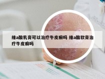 维a酸乳膏可以治疗牛皮癣吗 维a酸软膏治疗牛皮癣吗