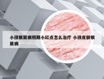 小孩银屑病初期小红点怎么治疗 小孩皮肤银屑病