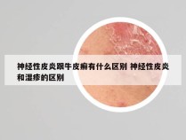 神经性皮炎跟牛皮癣有什么区别 神经性皮炎和湿疹的区别