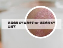 银屑病性关节炎患者的esr 银屑病性关节炎缩写