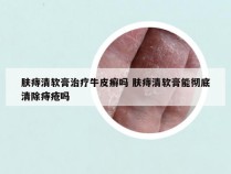 肤痔清软膏治疗牛皮癣吗 肤痔清软膏能彻底清除痔疮吗