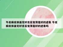 牛皮癣皮损面见好舌苔变薄是好的迹象 牛皮癣皮损面见好舌苔变薄是好的迹象吗