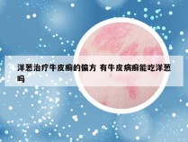 洋葱治疗牛皮癣的偏方 有牛皮病癣能吃洋葱吗