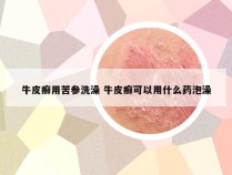 牛皮癣用苦参洗澡 牛皮癣可以用什么药泡澡