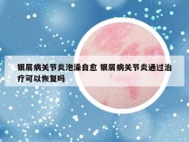 银屑病关节炎泡澡自愈 银屑病关节炎通过治疗可以恢复吗