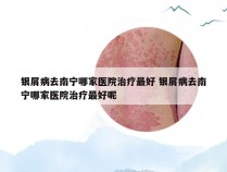 银屑病去南宁哪家医院治疗最好 银屑病去南宁哪家医院治疗最好呢