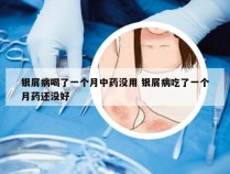 银屑病喝了一个月中药没用 银屑病吃了一个月药还没好