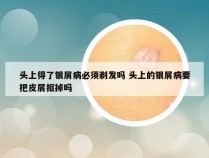 头上得了银屑病必须剃发吗 头上的银屑病要把皮屑抠掉吗