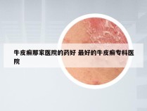 牛皮癣那家医院的药好 最好的牛皮癣专科医院