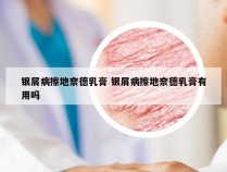银屑病擦地奈德乳膏 银屑病擦地奈德乳膏有用吗
