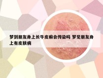 梦到朋友身上长牛皮癣会传染吗 梦见朋友身上有皮肤病