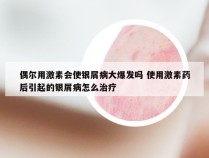偶尔用激素会使银屑病大爆发吗 使用激素药后引起的银屑病怎么治疗