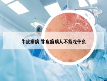 牛皮癣病 牛皮癣病人不能吃什么