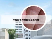 牛皮癣慢性病能补助多少钱