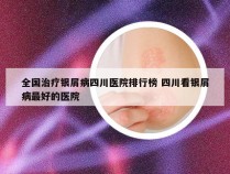 全国治疗银屑病四川医院排行榜 四川看银屑病最好的医院