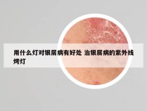 用什么灯对银屑病有好处 治银屑病的紫外线烤灯