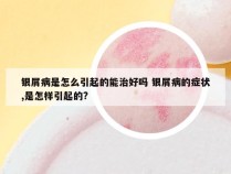 银屑病是怎么引起的能治好吗 银屑病的症状,是怎样引起的?