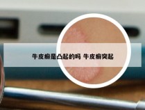 牛皮癣是凸起的吗 牛皮癣突起