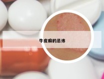 牛皮癣的忌讳