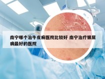 南宁哪个治牛皮癣医院比较好 南宁治疗银屑病最好的医院