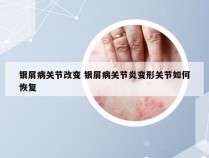 银屑病关节改变 银屑病关节炎变形关节如何恢复