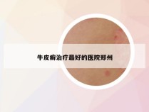 牛皮癣治疗最好的医院郑州