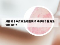 成都哪个牛皮癣治疗医院好 成都哪个医院治银屑病好?