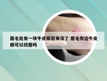 眉毛处有一块牛皮癣后来没了 眉毛旁边牛皮癣可以纹眉吗