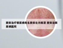 西安治疗银屑病有名西安北方精湛 西安治银屑病医院