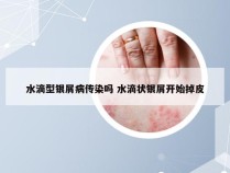水滴型银屑病传染吗 水滴状银屑开始掉皮